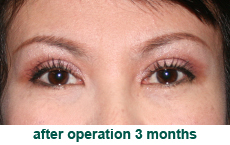 plastic-surgery-blepharoplasty